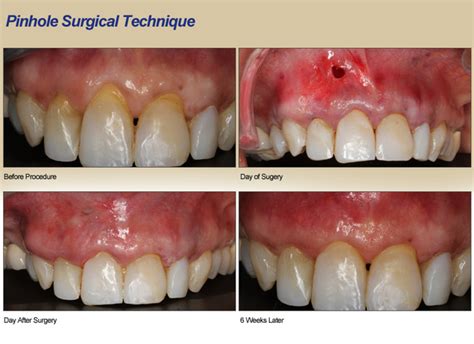 Pinhole Surgery – Vista Dental.